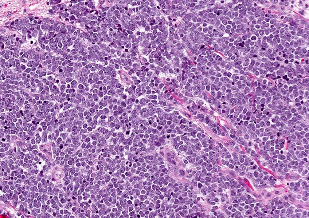 Merkel cell carcinoma histology 