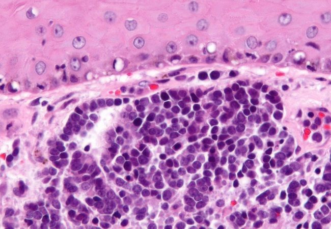 Merkel cell carcinoma