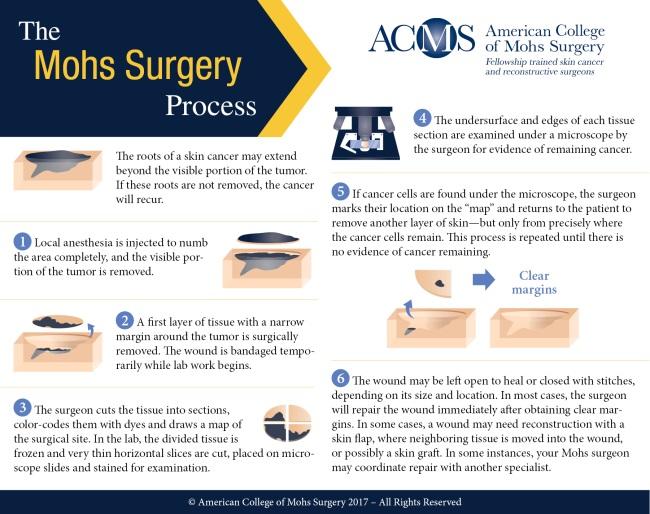 Mohs surgery process infographic